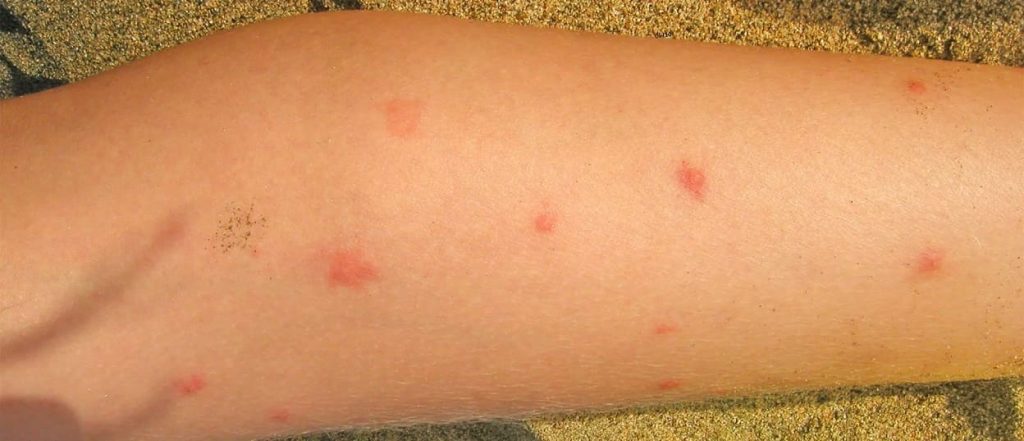 no see um bits on an arm